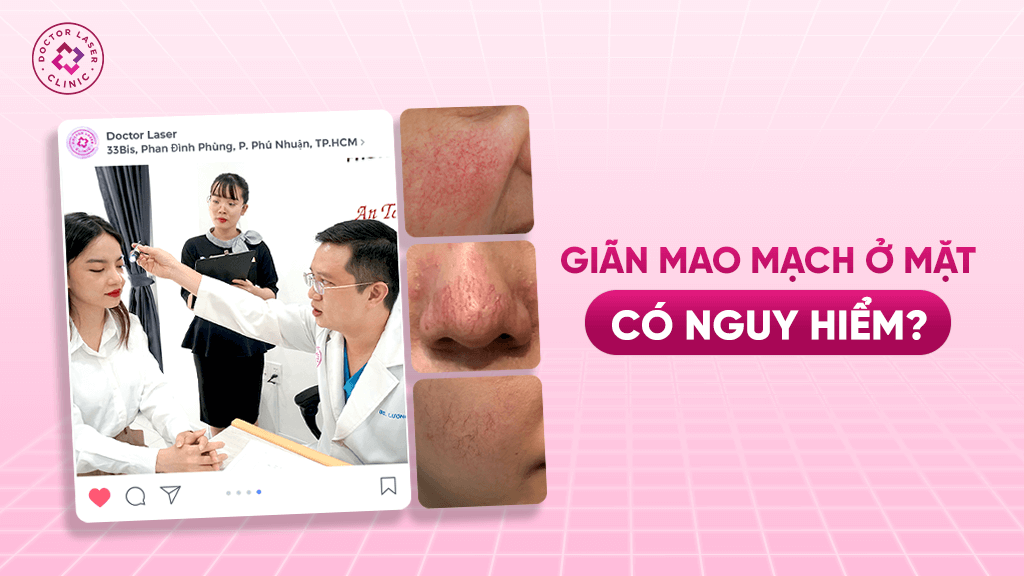 Giãn mao mạch ở mặt có nguy hiểm không?