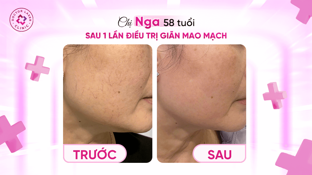 Khách hàng điều trị giãn mao mạch tại Doctor Laser