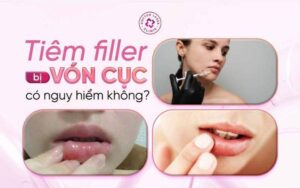 Tiêm filler bị vón cục có sao không?