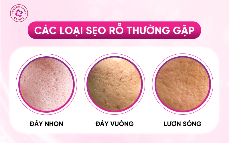 hình ảnh 3 loại sẹo rỗ phổ biến nhất hiện nay