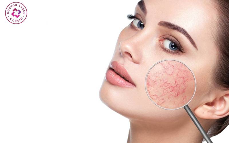 Hình ảnh người phụ nữ bị giãn mao mạch ở mặt