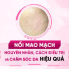 Nổi Mao Mạch: Nguyên Nhân, Cách Điều Trị & Chăm Sóc Da Hiệu Quả