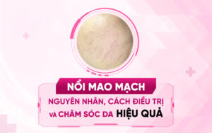 nổi mao mạch-nguyên nhân, cách điều trị và chăm sóc da hiệu quả