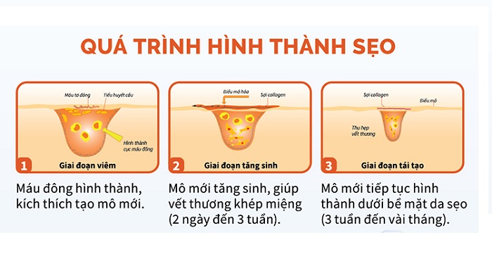 Các bước hình thành nên sẹo rỗ