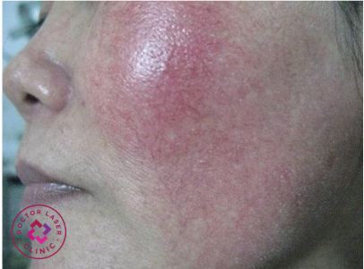 Da bị giãn mao mạch do sử dụng Corticoid.