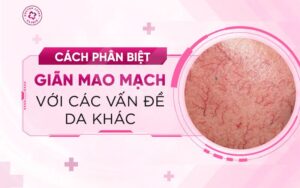 Cách phân biệt giãn mao mạch và các vấn đề da khác