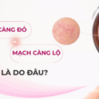 GIÃN MAO MẠCH: CHẾ ĐỘ ĂN & LỐI SỐNG ẢNH HƯỞNG THẾ NÀO?