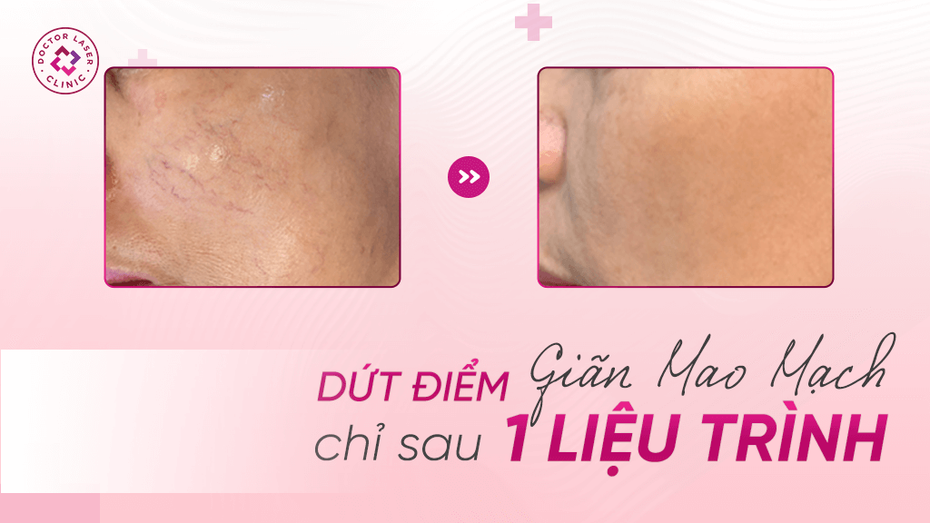 Dứt điểm giãn mao mạch chỉ sau 1 liệu trình