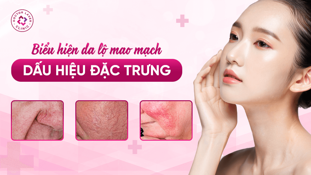 Biểu hiện đặc trưng của da lộ mao mạch với các vệt đỏ tím li ti