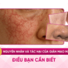 Nguyên nhân và tác hại của giãn mao mạch: 3 Điều bạn cần biết