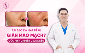 Tại sao da mặt dễ bị giãn mao mạch