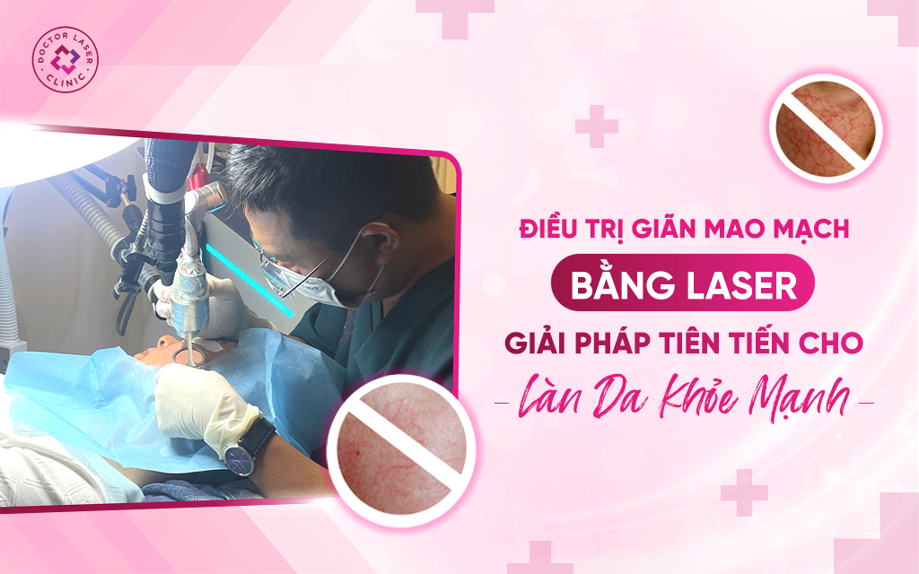 Điều trị giãn mao mạch bằng Laser