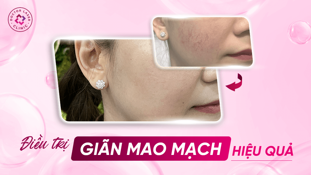 Hiệu quả của Laser MagicVeins trong trị giãn mao mạch