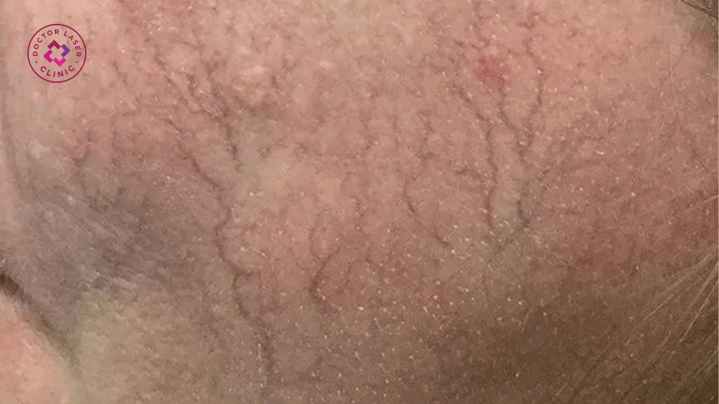 Lưu ý quan trọng trước và sau khi trị liệu laser giãn mao mạch