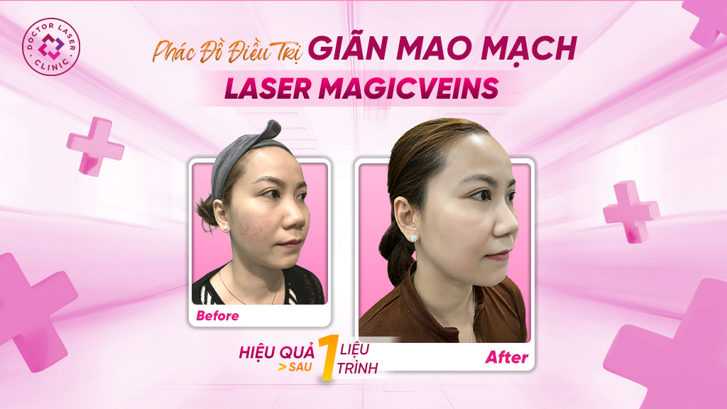 Phác đồ điều trị giãn mao mạch Laser MagicVeins