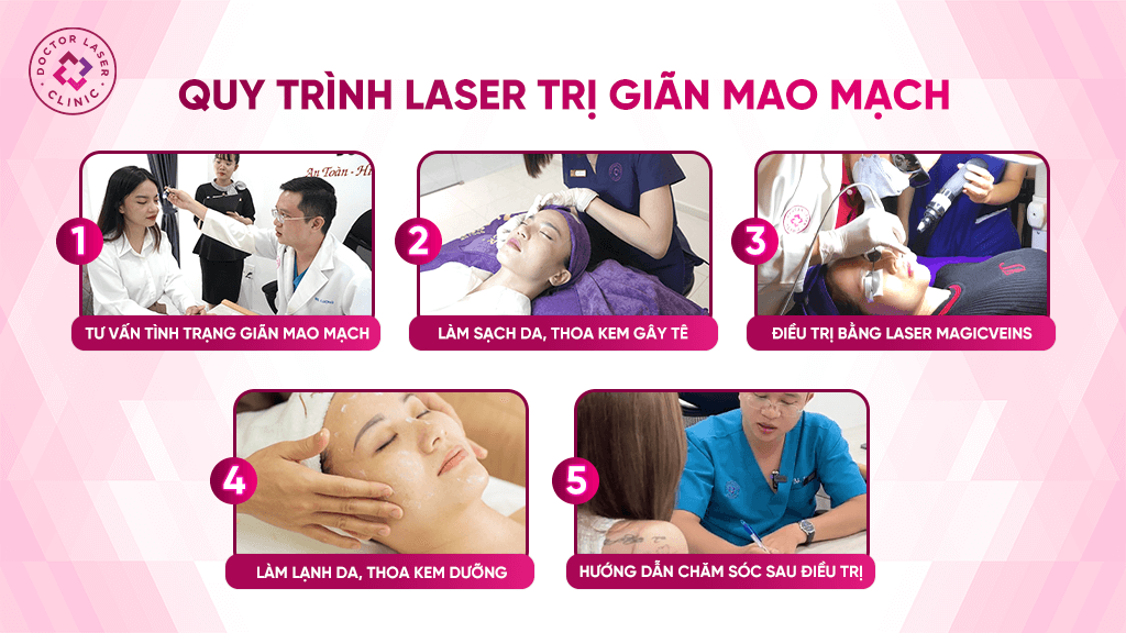 Quy trình điều trị laser giãn mao mạch