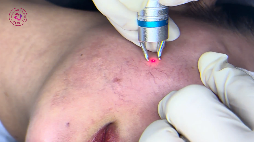 Công nghệ laser và hiệu quả trong điều trị giãn mao mạch