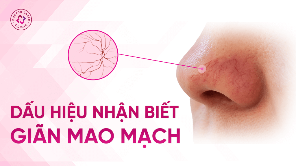Dấu hiệu giãn mao mạch trên da mặt