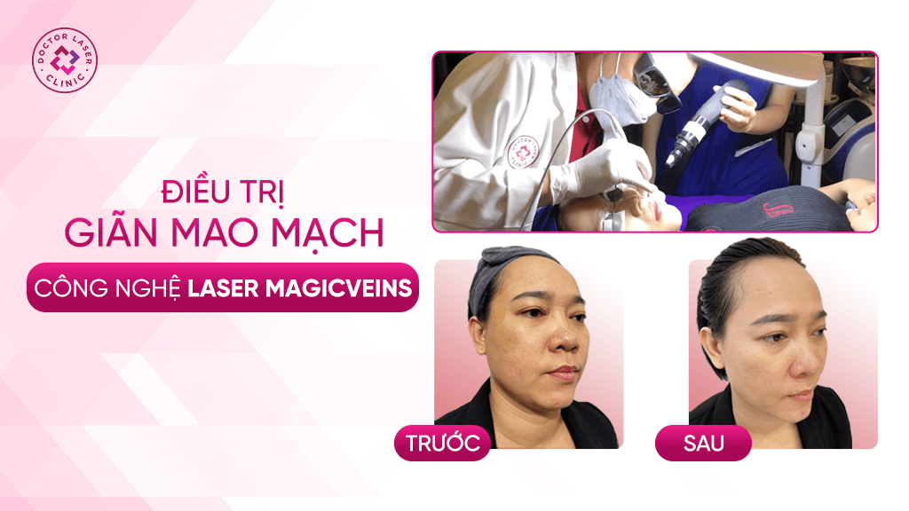 Giãn mao mạch là gì