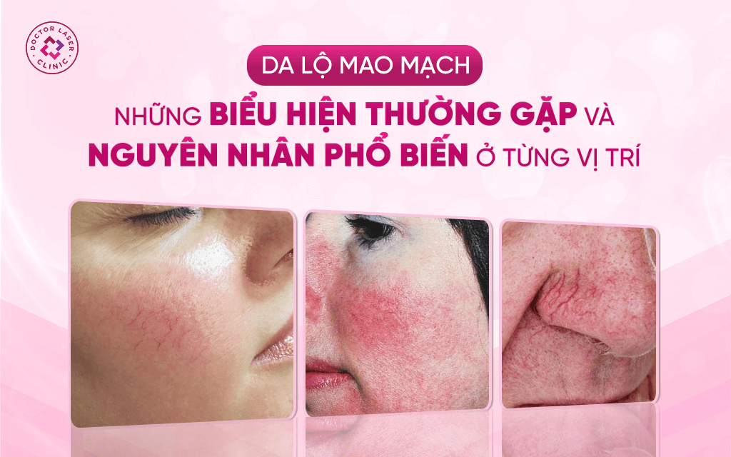 Các vị trí da mặt thường bị giãn mao mạch và nguyên nhân phổ biến