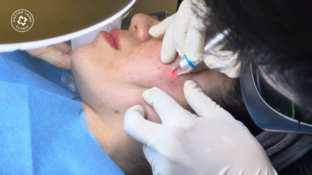 Điều trị bằng công nghệ Laser MagicVeins chuẩn Mỹ
