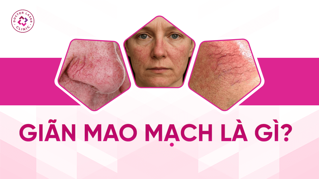 Giãn mao mạch là gì