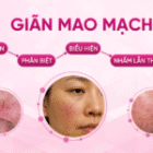 Giãn mao mạch: Tổng quan, phân biệt, biểu hiện và nhầm lẫn thường gặp