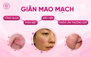Giãn mao mạch Tổng quan, phân biệt, biểu hiện và nhầm lẫn thường gặp