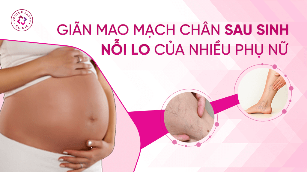 Giãn mao mạch chân sau sinh