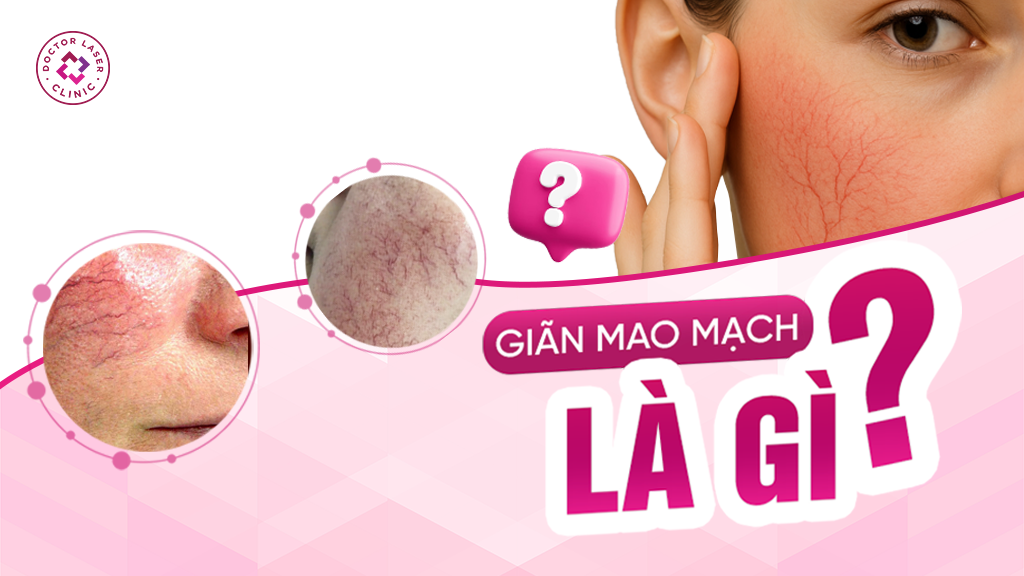 Giãn mao mạch là gì