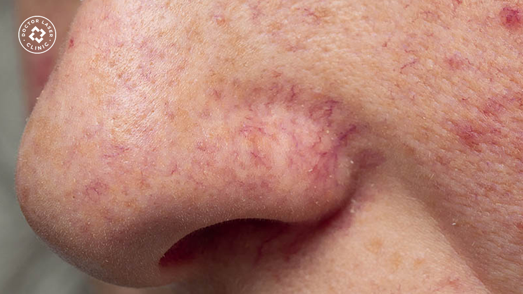 Giãn mao mạch và những ảnh hưởng khi tiêm filler
