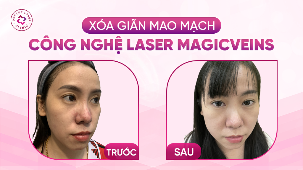 Hiệu quả và thời gian phục hồi giãn mao mạch