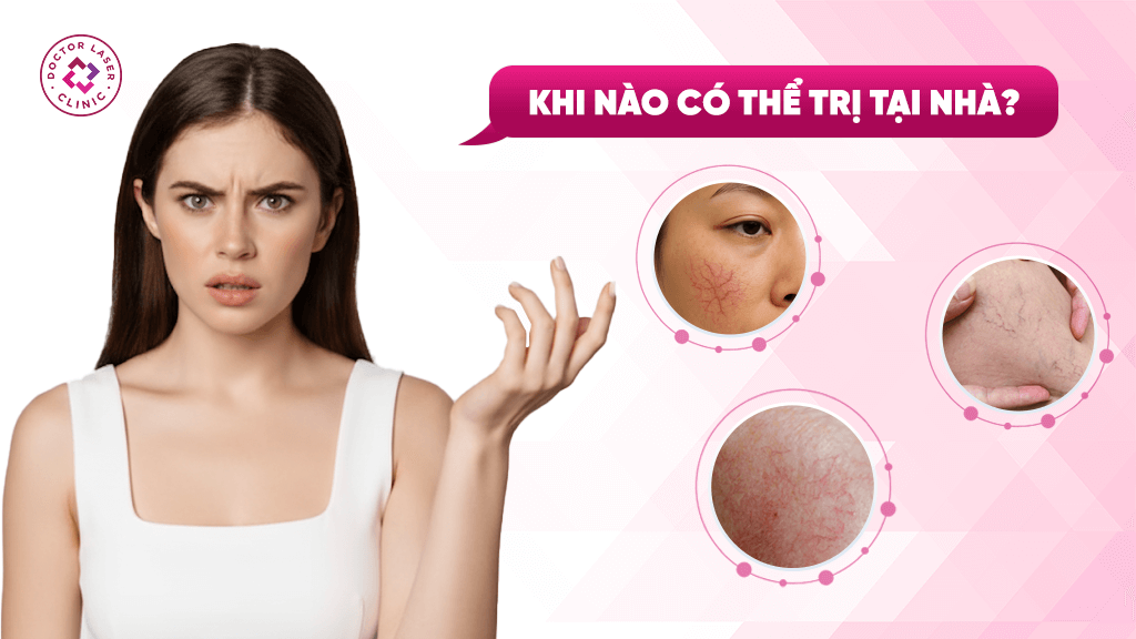 Nhận biết trường hợp giãn mao mạch có thể điều trị tại nhà