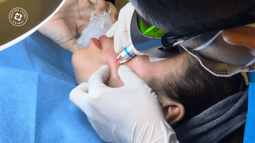 Ứng dụng công nghệ laser hiện đại trong điều trị giãn mao mạch
