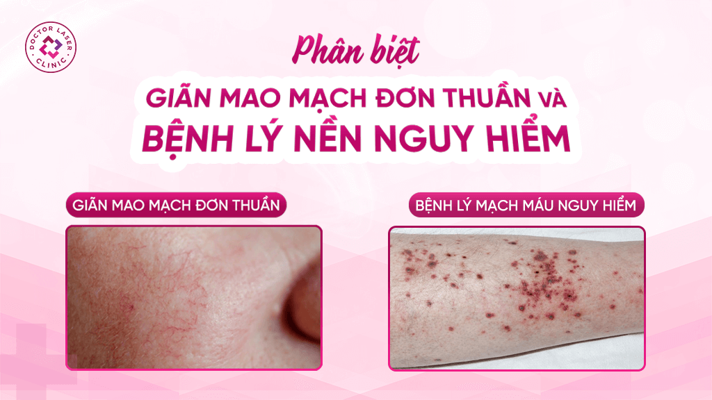 Phân biệt giãn mao mạch đơn thuần và bệnh lý nền nguy hiểm