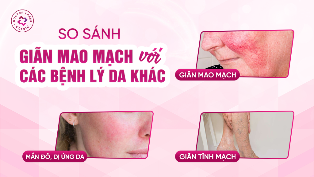 So sánh giãn mao mạch với các bệnh lý da khác