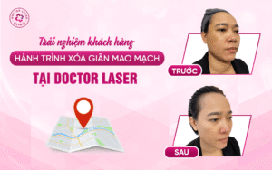 Trải nghiệm khách hàng Hành trình xóa giãn mao mạch tại Doctor Laser