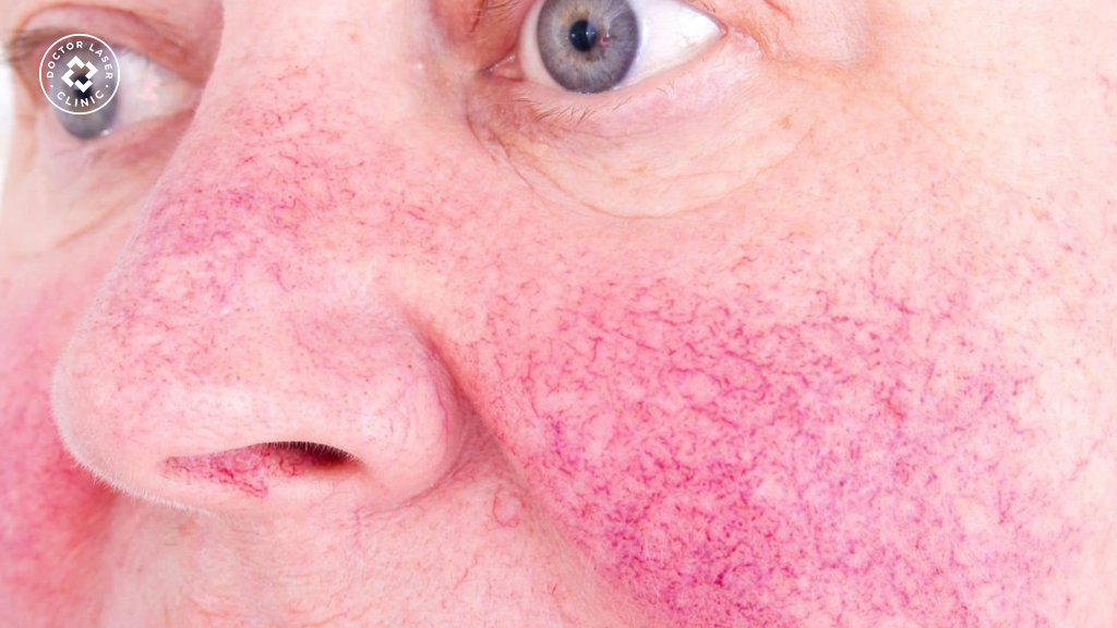 Ý kiến chuyên gia thẩm mỹ về tiêm filler cho da giãn mao mạch