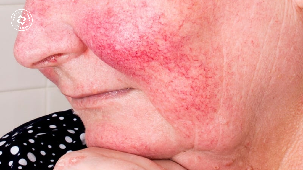 Giãn mao mạch yếu tố bẩm sinh và di truyền