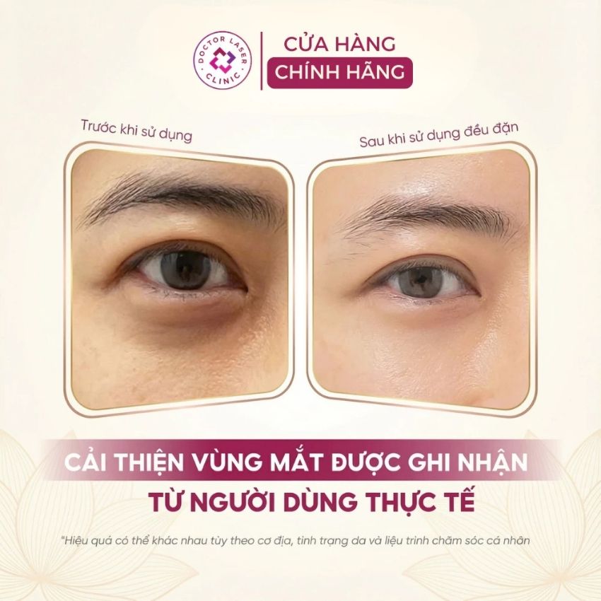 ket-qua-cai-thien-bong-mat-sau-khi-su-dung-eyelift-serum Serum trị thâm mắt Dr. Clariv dưỡng sáng vùng mắt 20ml - Ảnh 4