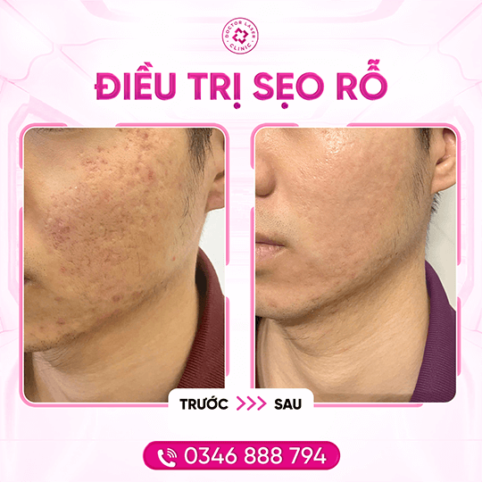 BF-AT_Trí Nhân_sẹo_16.7.24