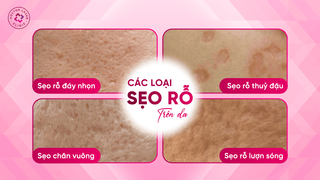 Các loại sẹo rỗ