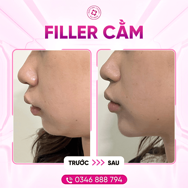 Chị Trinh_20.1.24_filler cằm