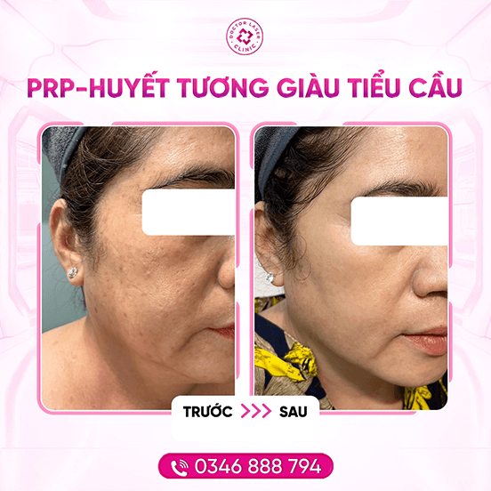 Dung_prp