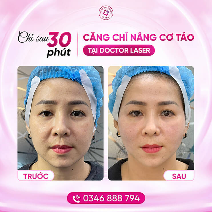 FB_Huyền Trang_căng chỉ nâng cơ táo