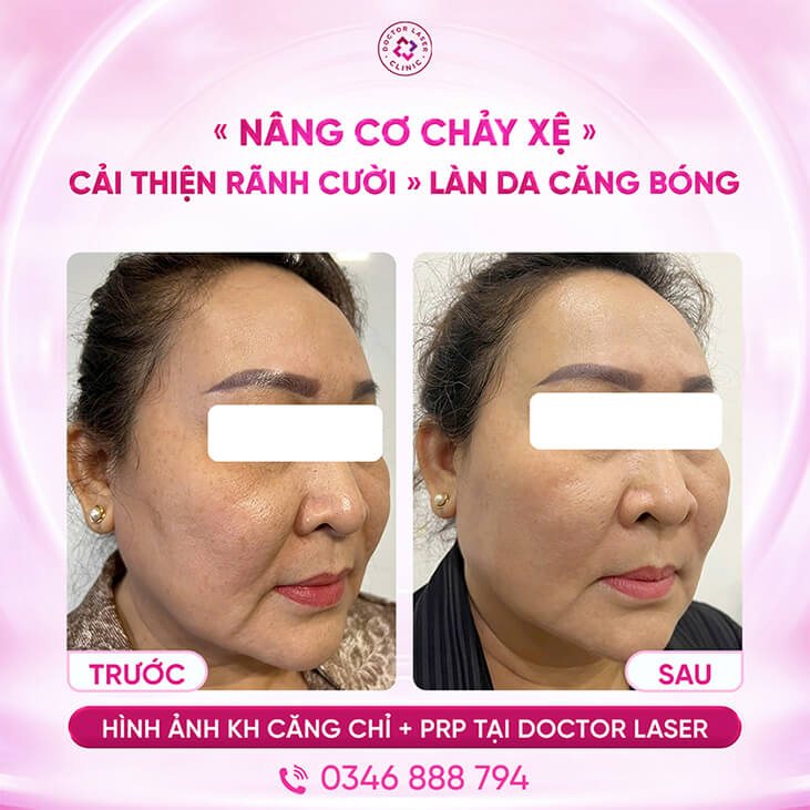 FB_Kiều Nhi_Căng chỉ kéo cơ-29.11.24_PRP-14.3.25