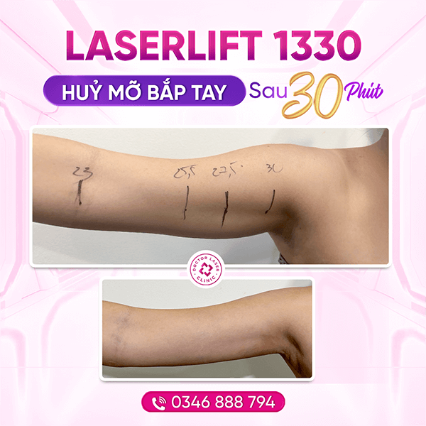 Hoàng Mai_22.12.23_laserlift bắp tay