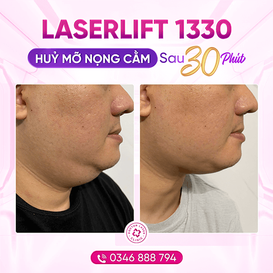 Hoàng_laserlift nọng cằm
