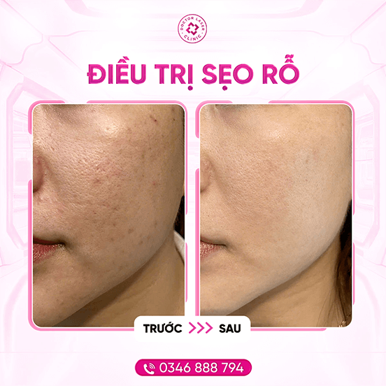 Mỹ Hạnh_sẹo_30.10.24-laser co2_2.6.25