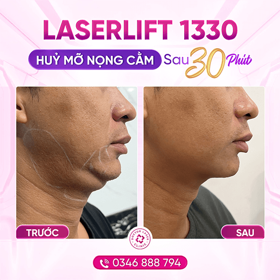 Văn Đức_laserlift nọng cằm_31.8.24